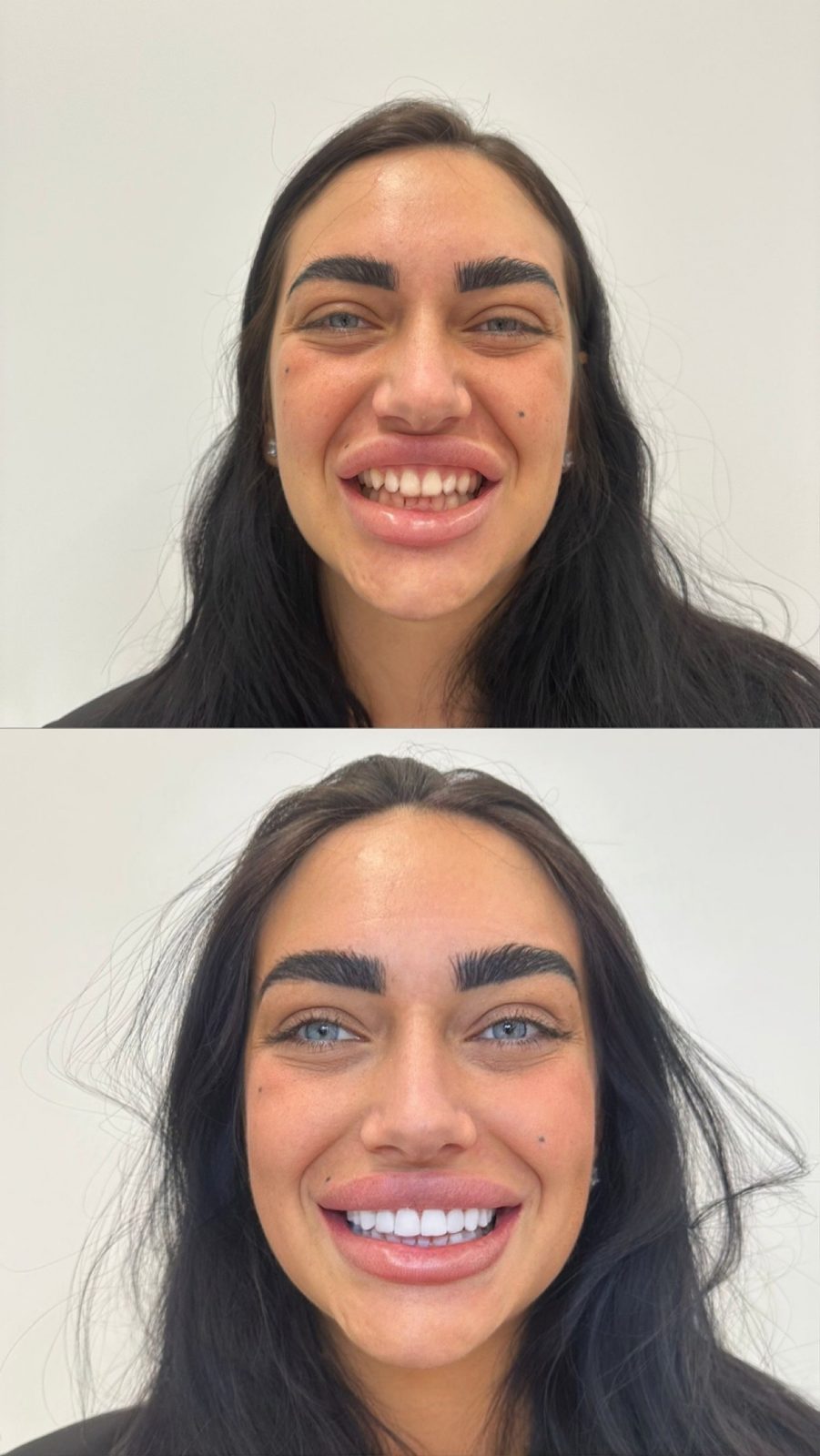 Voor en na resultaat van een composiet Hollywood Smile bij Qualident