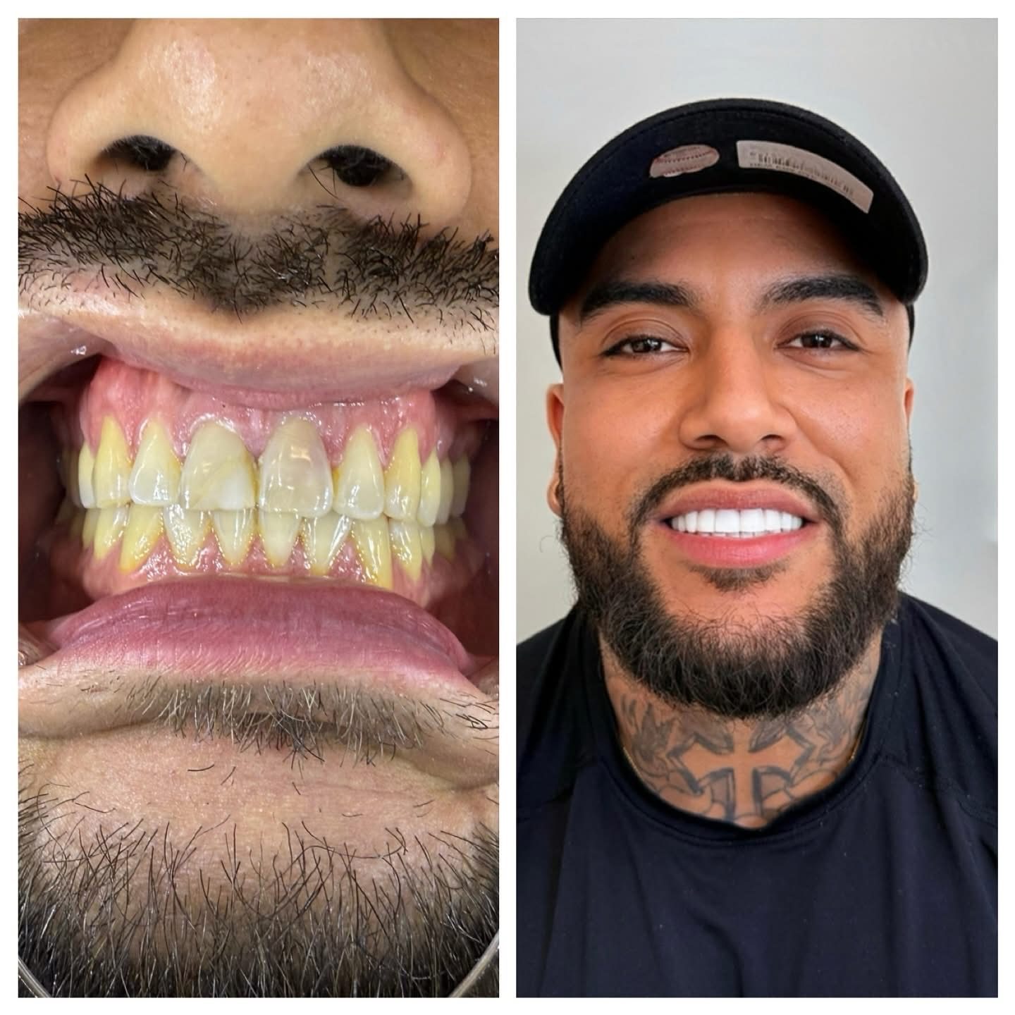Voor en na close-up van een composiet Hollywood Smile behandeling bij Qualident