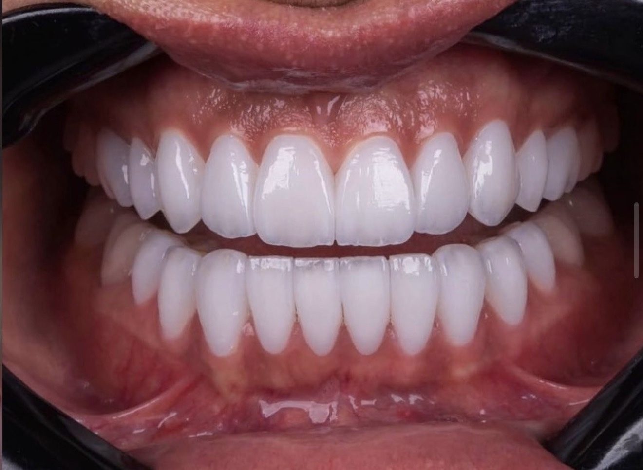 Close-up van E-Max facings direct na de behandeling bij Qualident